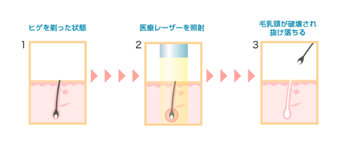 医療レーザー仕組み