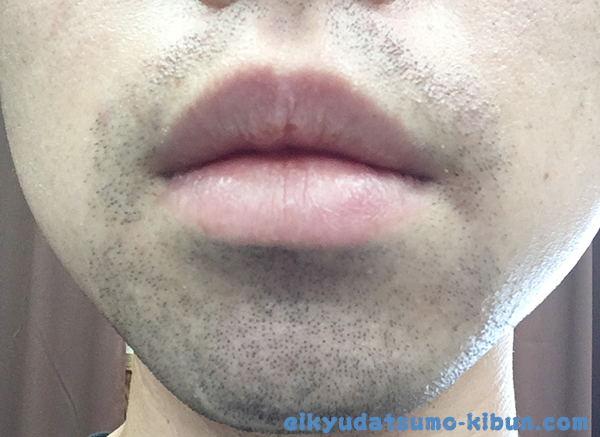 1回目終了後のヒゲ