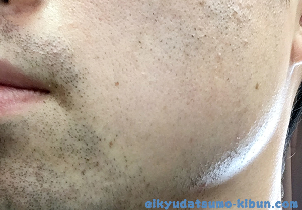 1回目終了後のヒゲ２