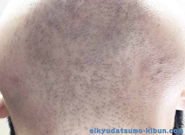 1回目終了後のヒゲ３