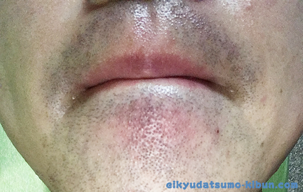 2回目終了後のヒゲ１