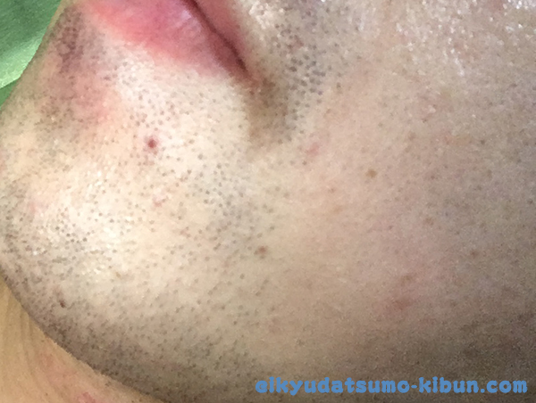 2回目終了後のヒゲ２