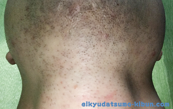 2回目終了後のヒゲ３