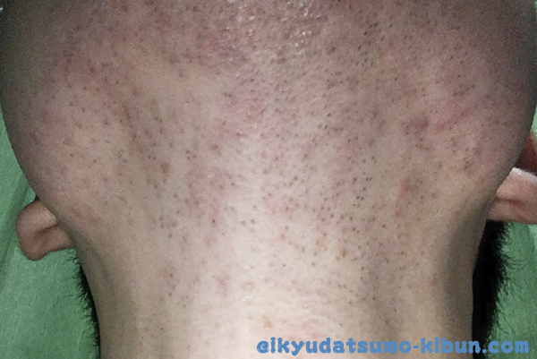 3回目終了後喉アゴ下