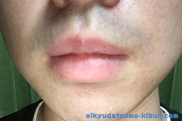 4回目終了後ヒゲ1