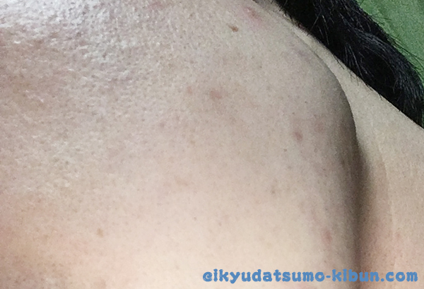 4回目終了後ヒゲ2