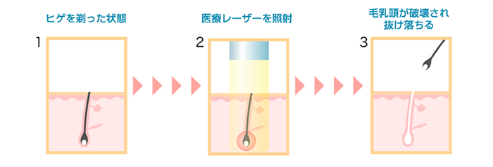 医療レーザーの仕組み