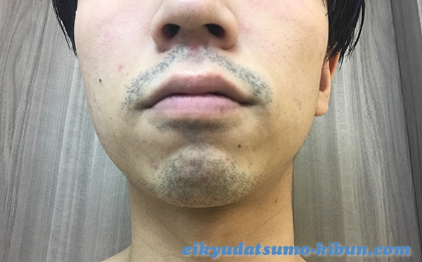 湘南ヒゲ脱毛する前の髭
