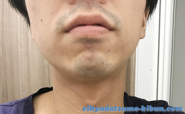 湘南ヒゲ脱毛直後の髭肌の状態