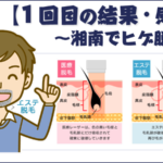 非公開: 【湘南ヒゲ脱毛１回目】少しだけど効果あり！部位ごとの結果と感想