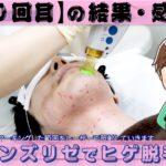 非公開: 【メンズリゼ10回目終了後】ヒゲの部位ごとの脱毛結果と感想