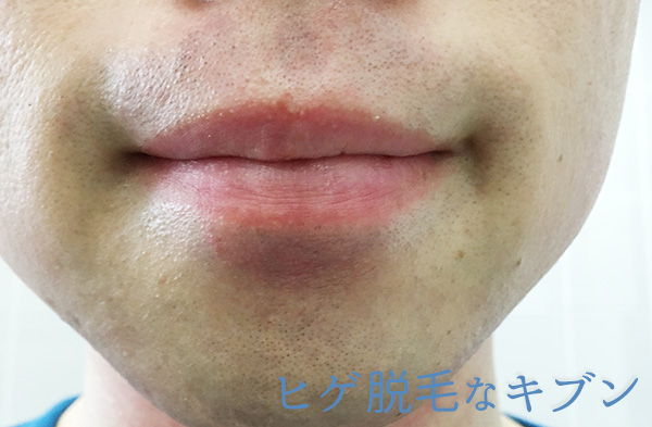 ヒゲ脱毛11回目直後髭口周り