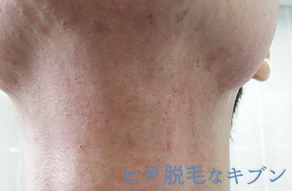 ヒゲ脱毛11回目直後髭喉アゴ下