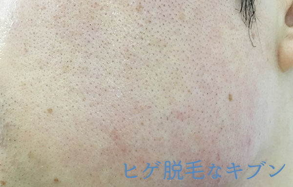 ヒゲ脱毛11回目直後髭頬もみあげ