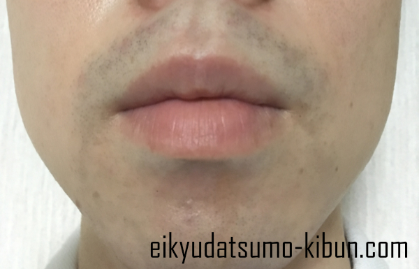 ヒゲ脱毛12回目直後口周り