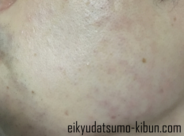 ヒゲ脱毛12回目直後頬もみあげ