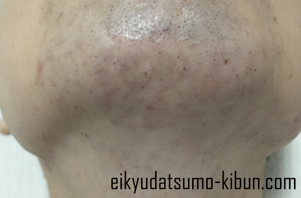 ヒゲ脱毛12回目直後あご下首